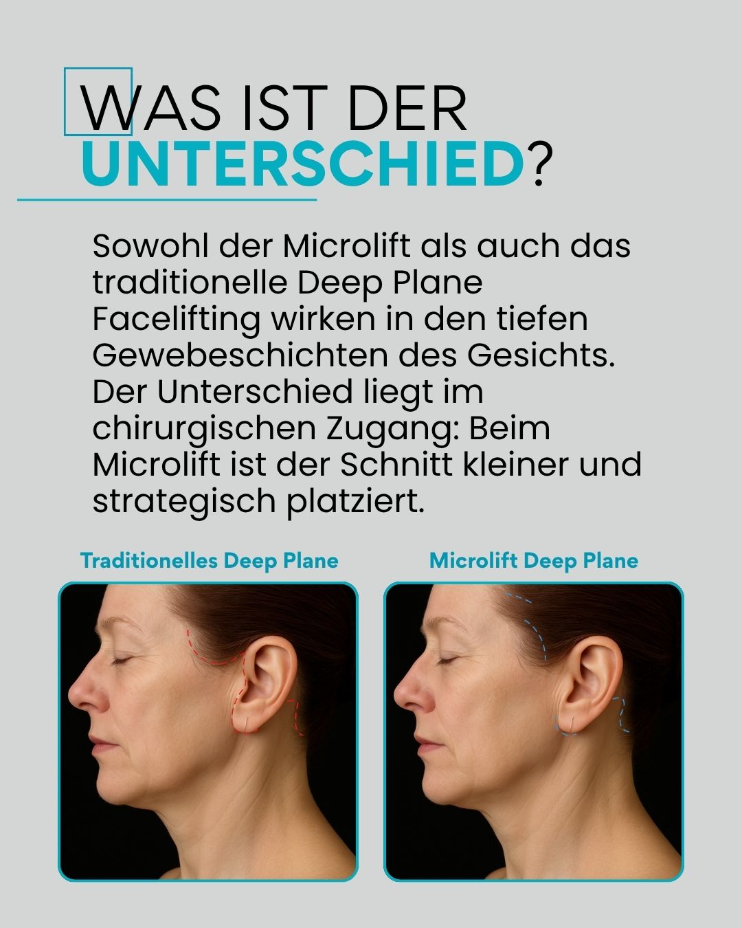 Was ist der Unterschied? Sowohl der Microlift als auch das traditionelle Deep Plane Facelifting wirken in den tiefen Gewebeschichten des Gesichts. Der Unterschied liegt im chirurgischen Zugang: Beim Microlift ist der Schnitt kleiner und strategisch platziert.