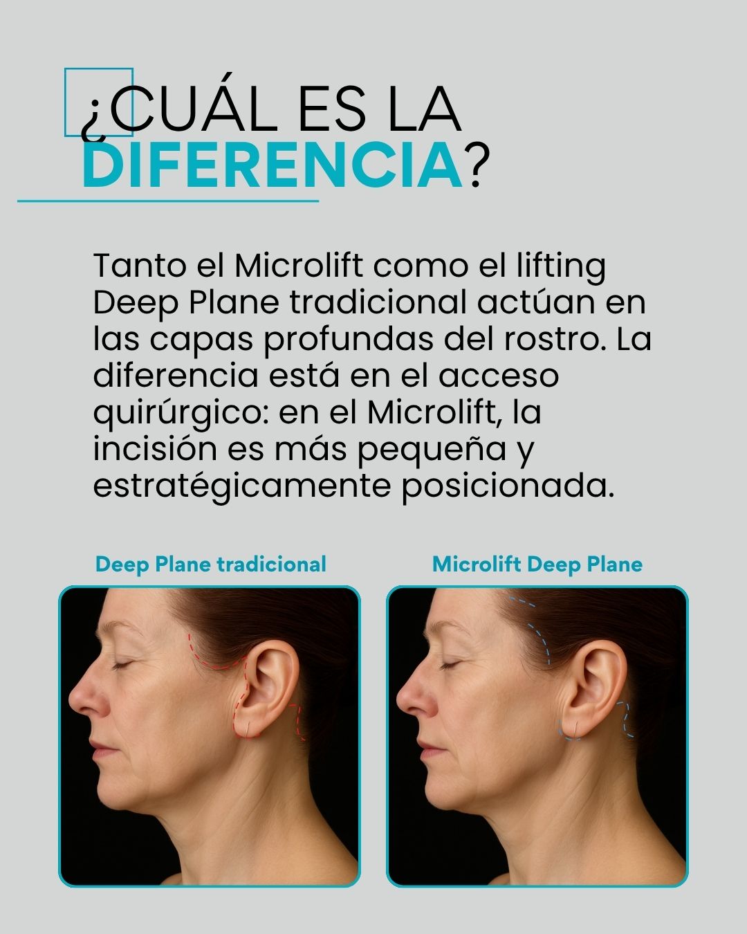 ¿Cuál es la diferencia? Tanto el Microlift como el lifting Deep Plane tradicional actúan en las capas profundas del rostro. La diferencia está en el acceso quirúrgico: en el Microlift, la incisión es más pequeña y estratégicamente posicionada.