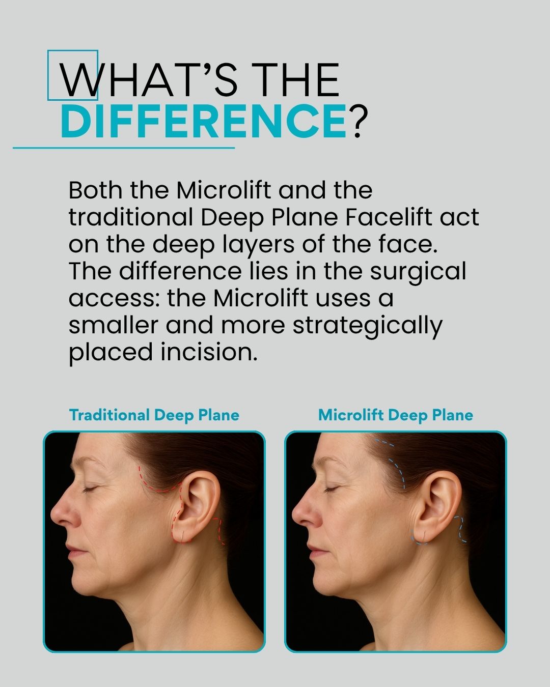 What’s the difference? Both the Microlift and the traditional Deep Plane Facelift act on the deep layers of the face. The difference lies in the surgical access: the Microlift uses a smaller and more strategically placed incision.