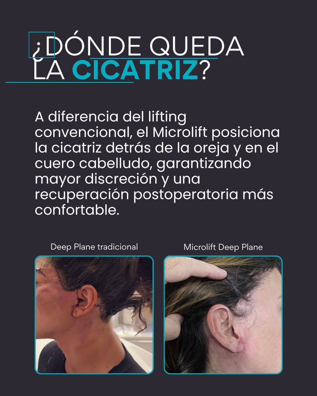 ¿Dónde queda la cicatriz? A diferencia del lifting convencional, el Microlift posiciona la cicatriz detrás de la oreja y en el cuero cabelludo, garantizando mayor discreción y una recuperación postoperatoria más confortable.