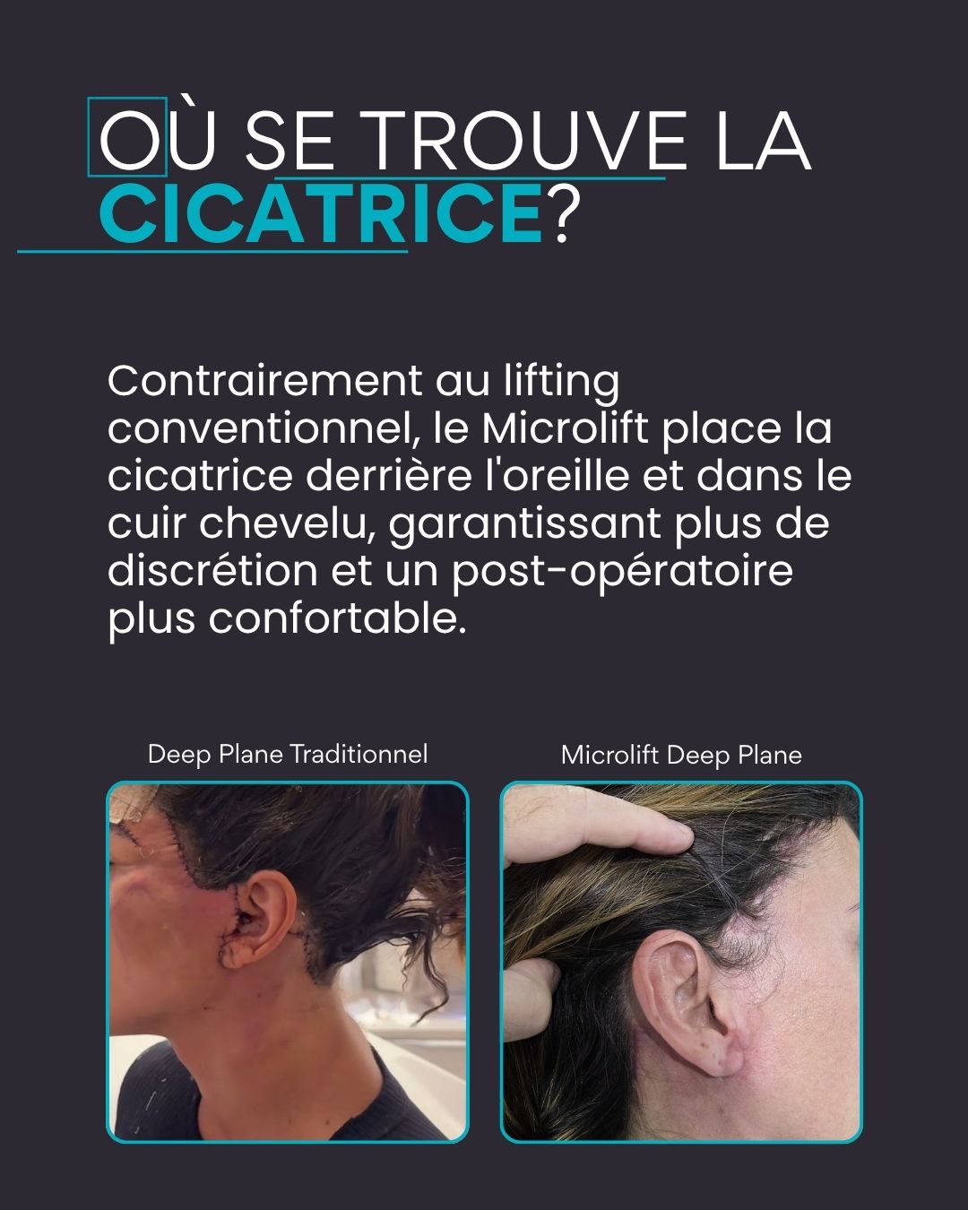 Où se trouve la cicatrice ? Contrairement au lifting conventionnel, le Microlift place la cicatrice derrière l'oreille et dans le cuir chevelu, garantissant plus de discrétion et un post-opératoire plus confortable.