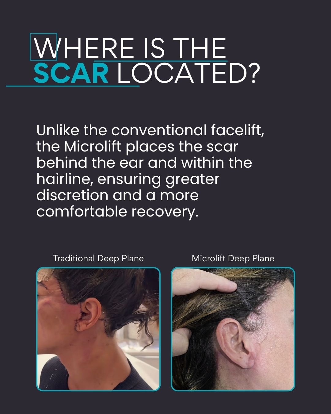 Where is the scar located? Unlike the conventional facelift, the Microlift places the scar behind the ear and within the hairline, ensuring greater discretion and a more comfortable recovery.