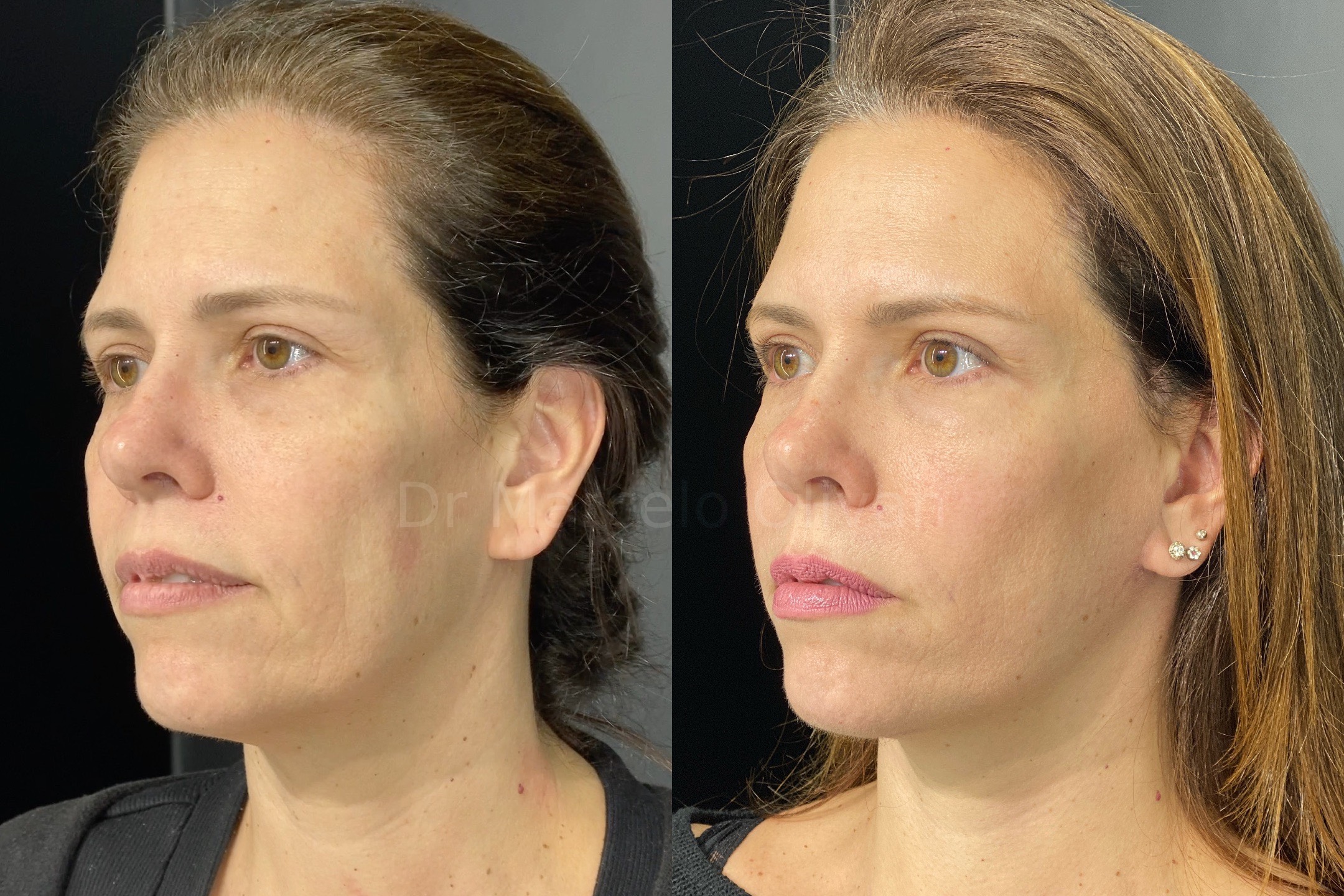 Before and after - angle view