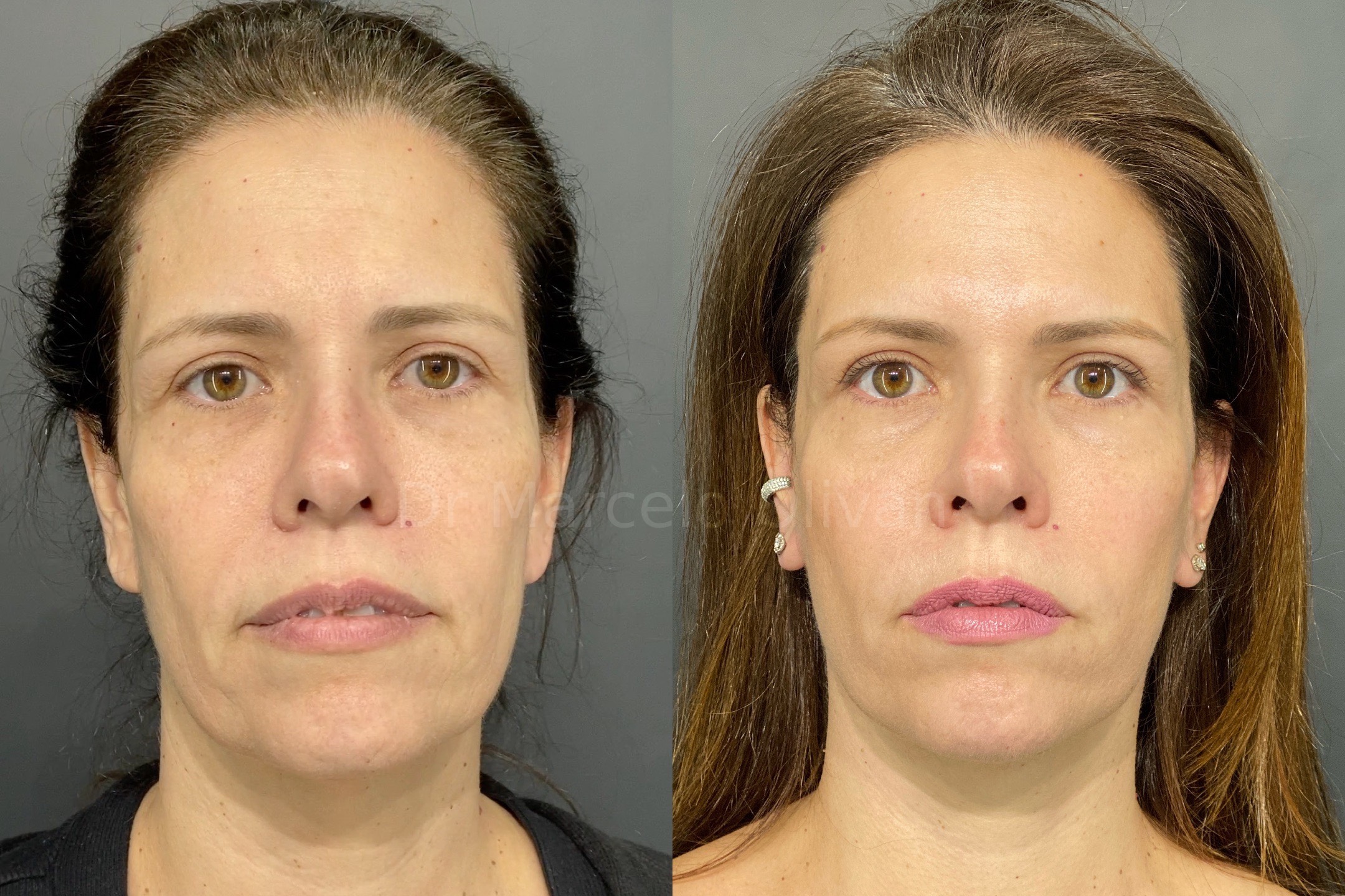 Before and after - frontal view