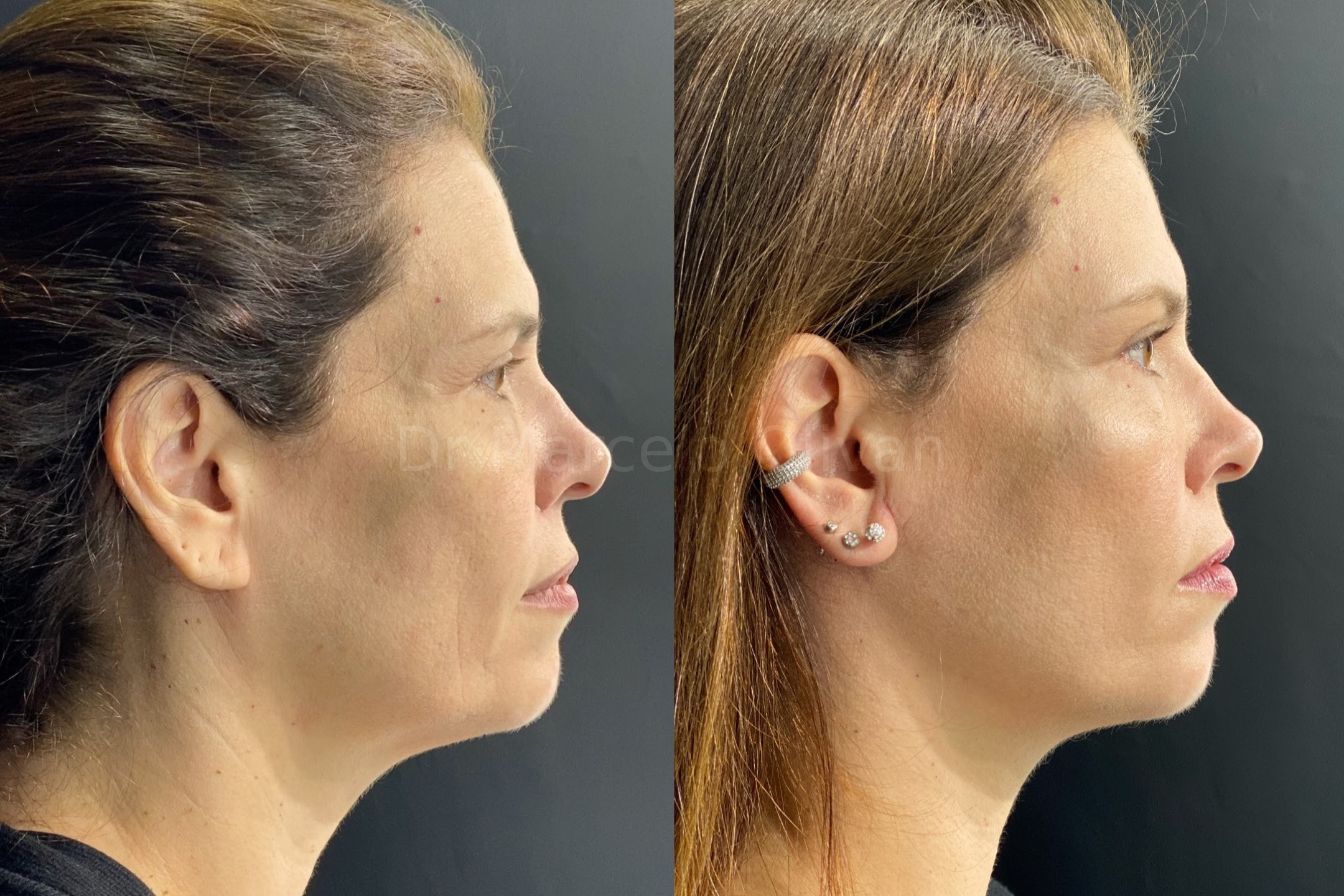 Before and after - side view