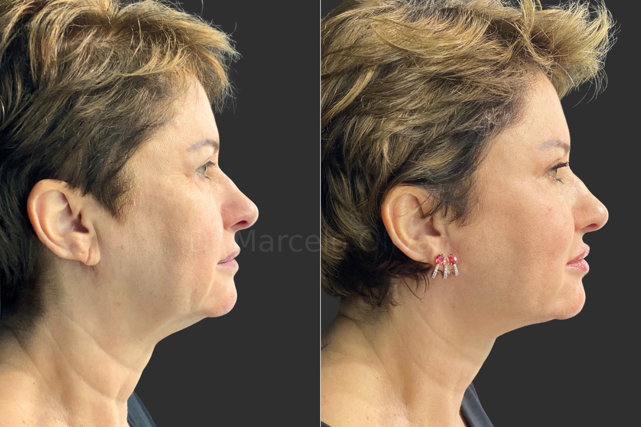 Before and after - right side view