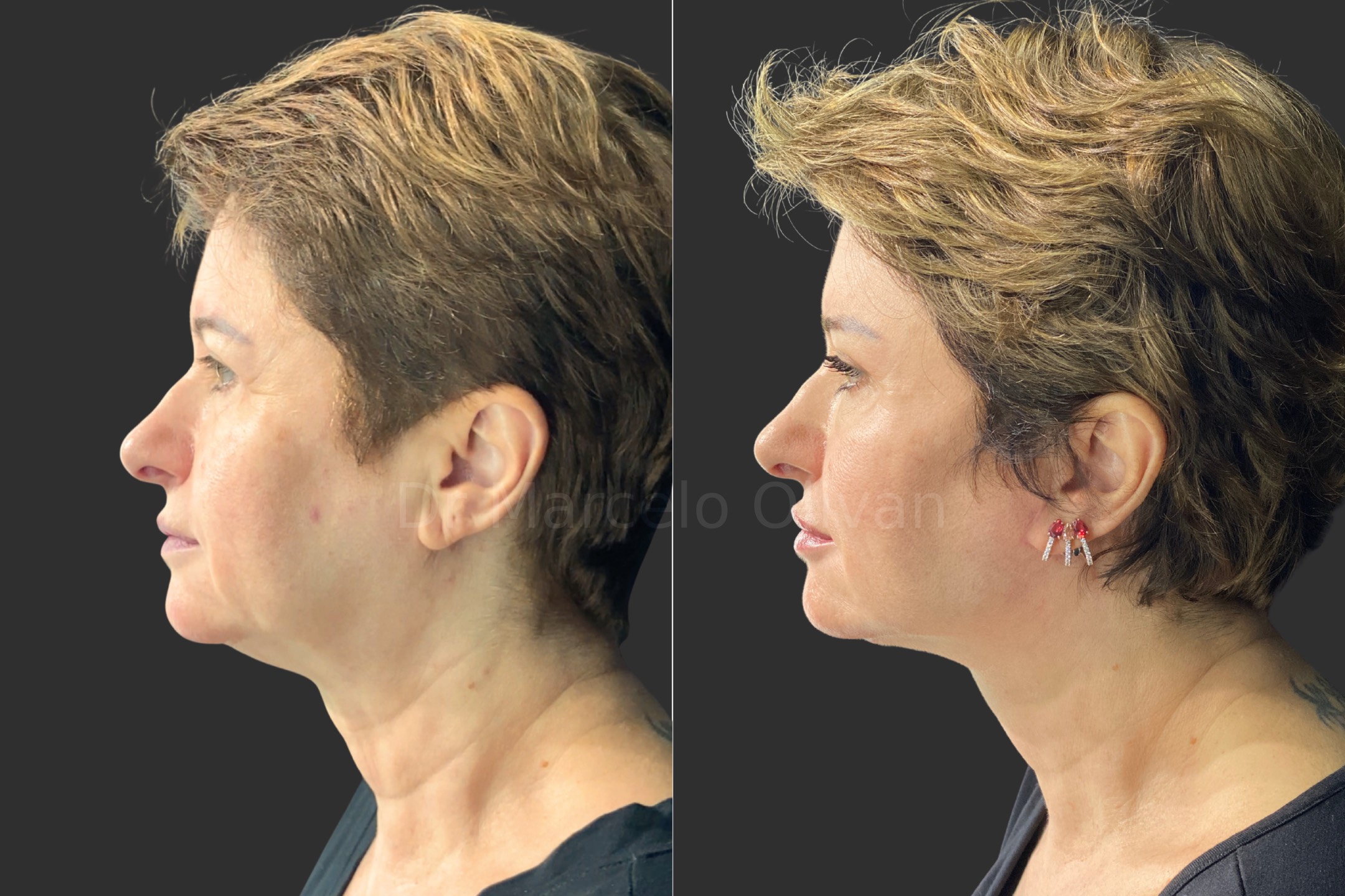 Before and after - left side view