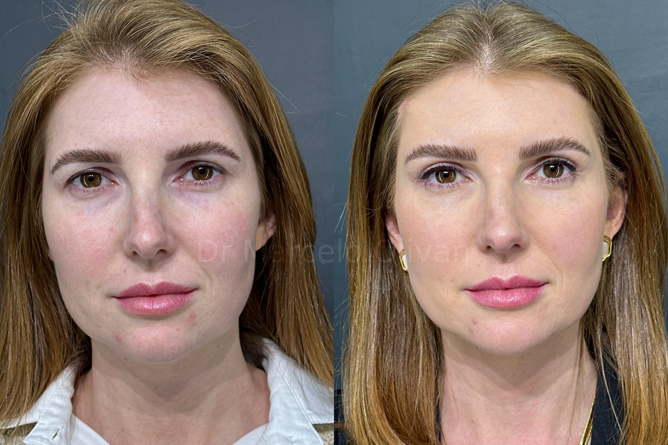 Before and after - frontal view