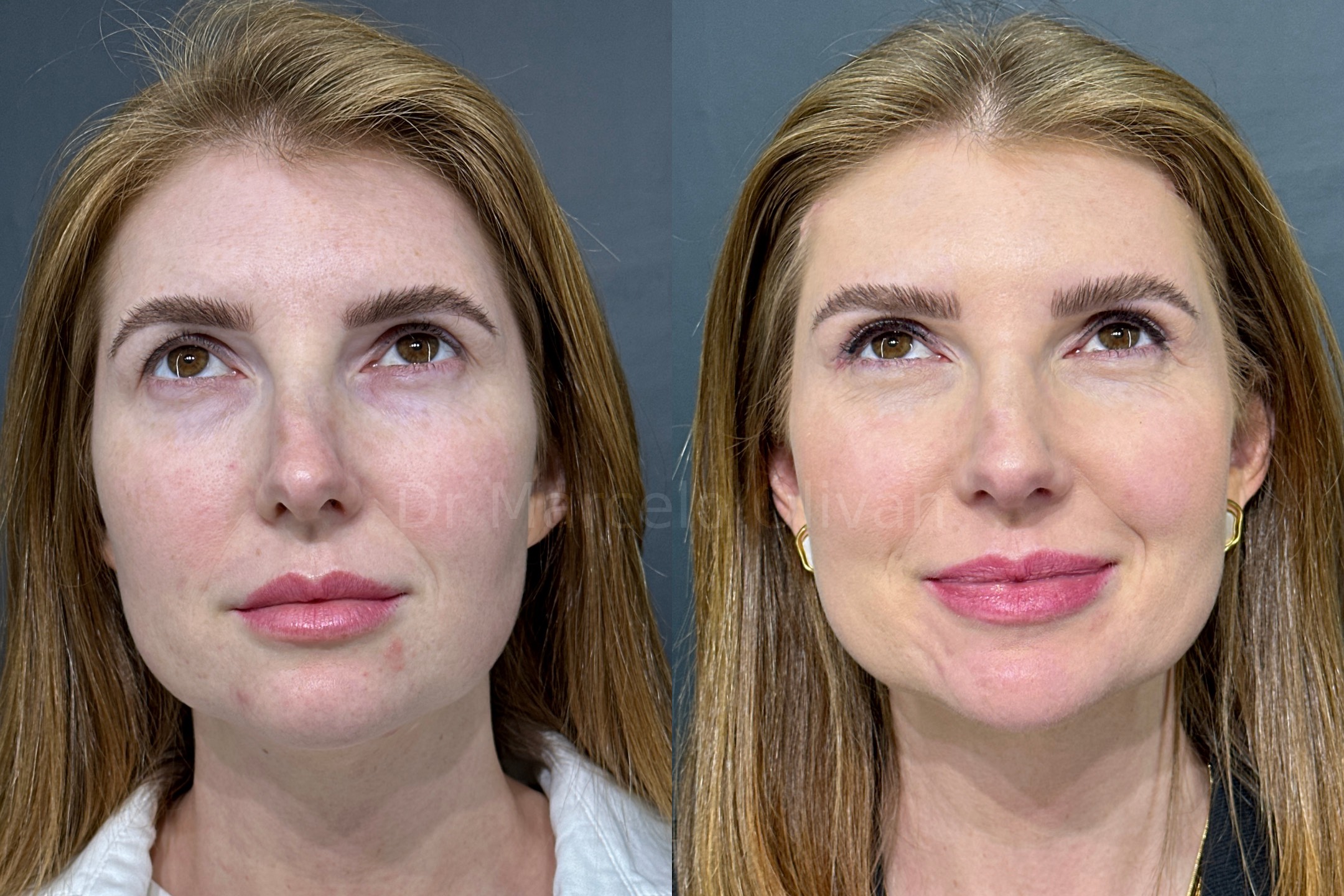 Before and after - frontal view B