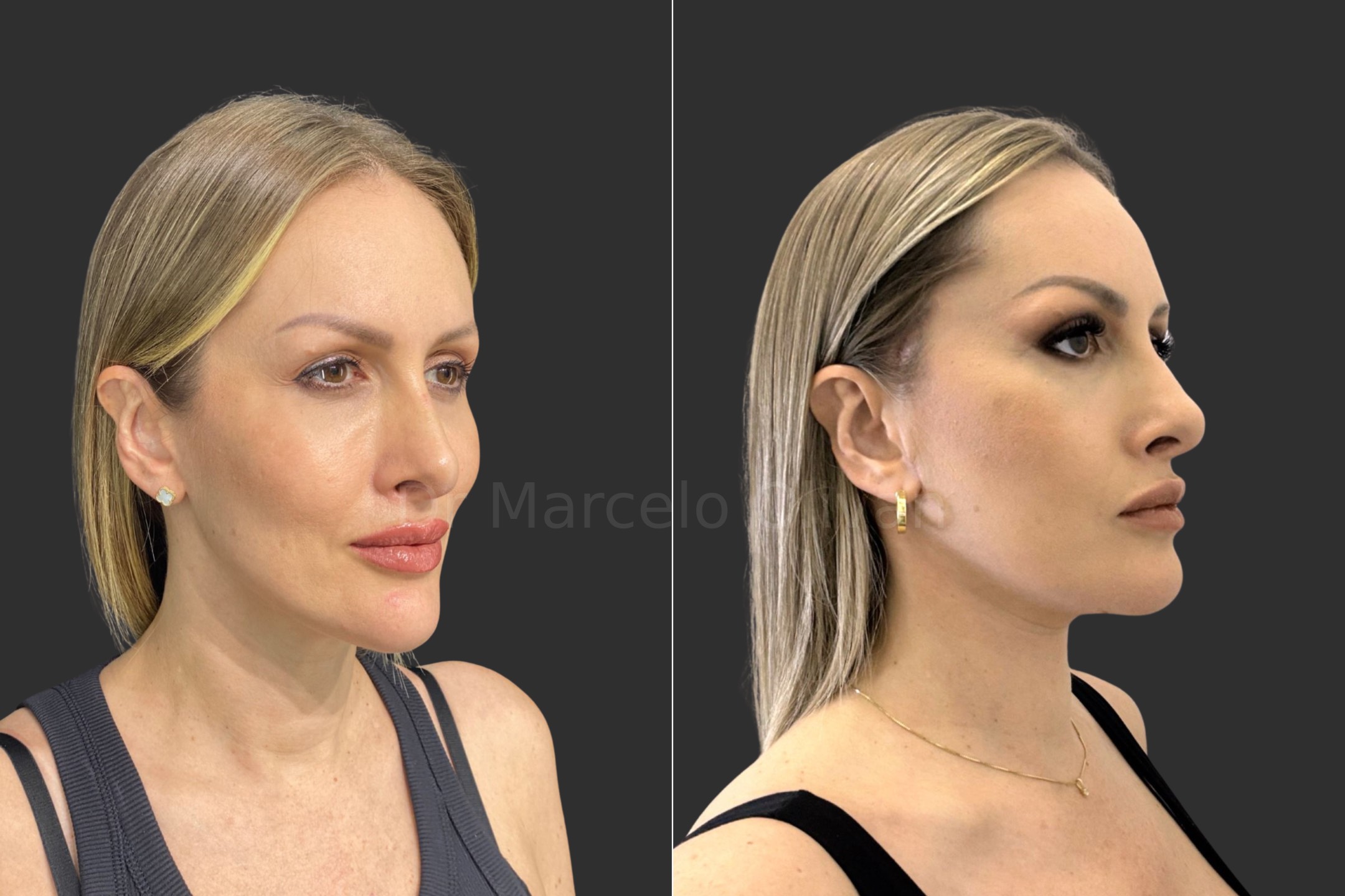 Before and after - angle view