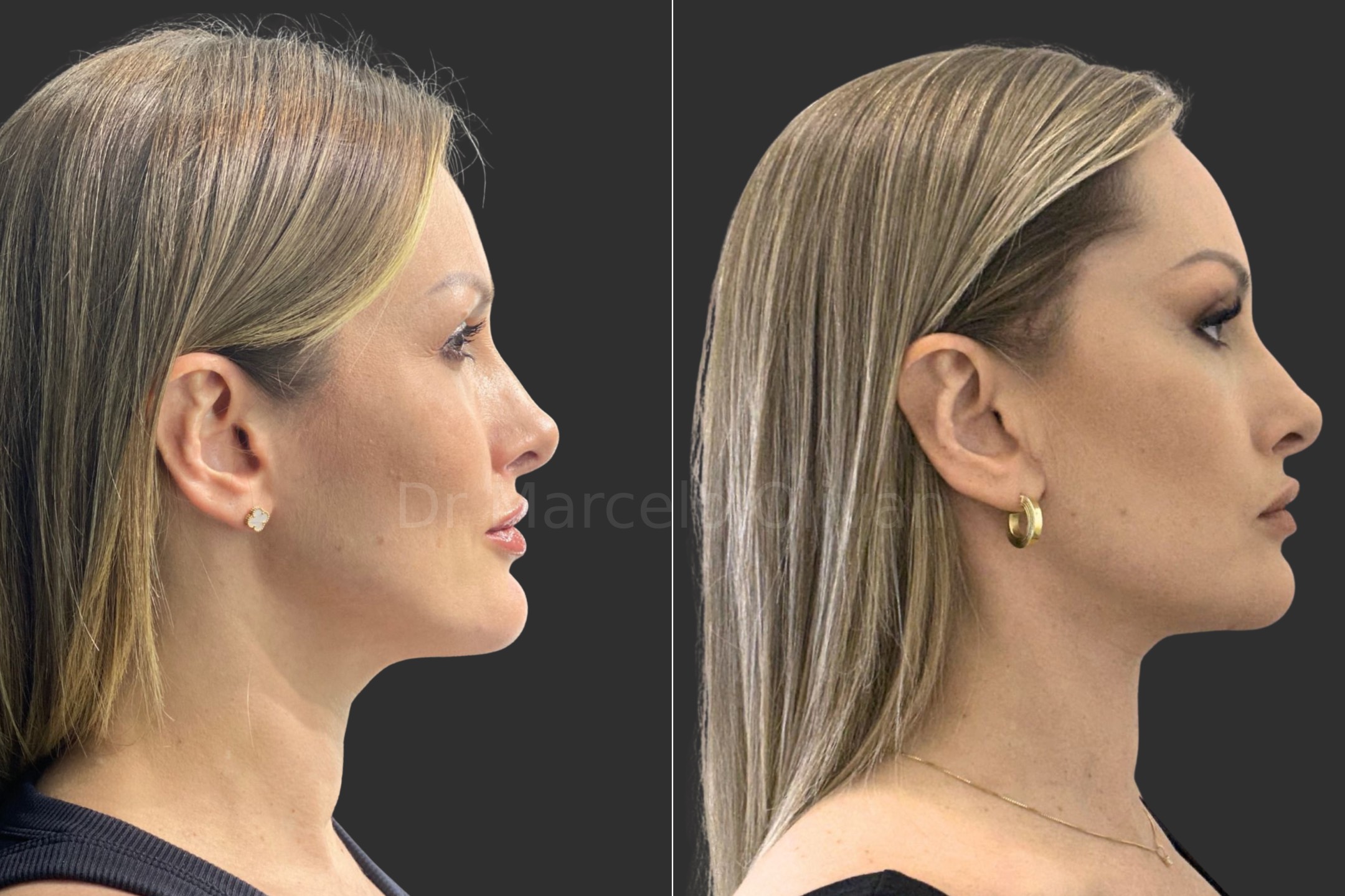 Before and after - side view