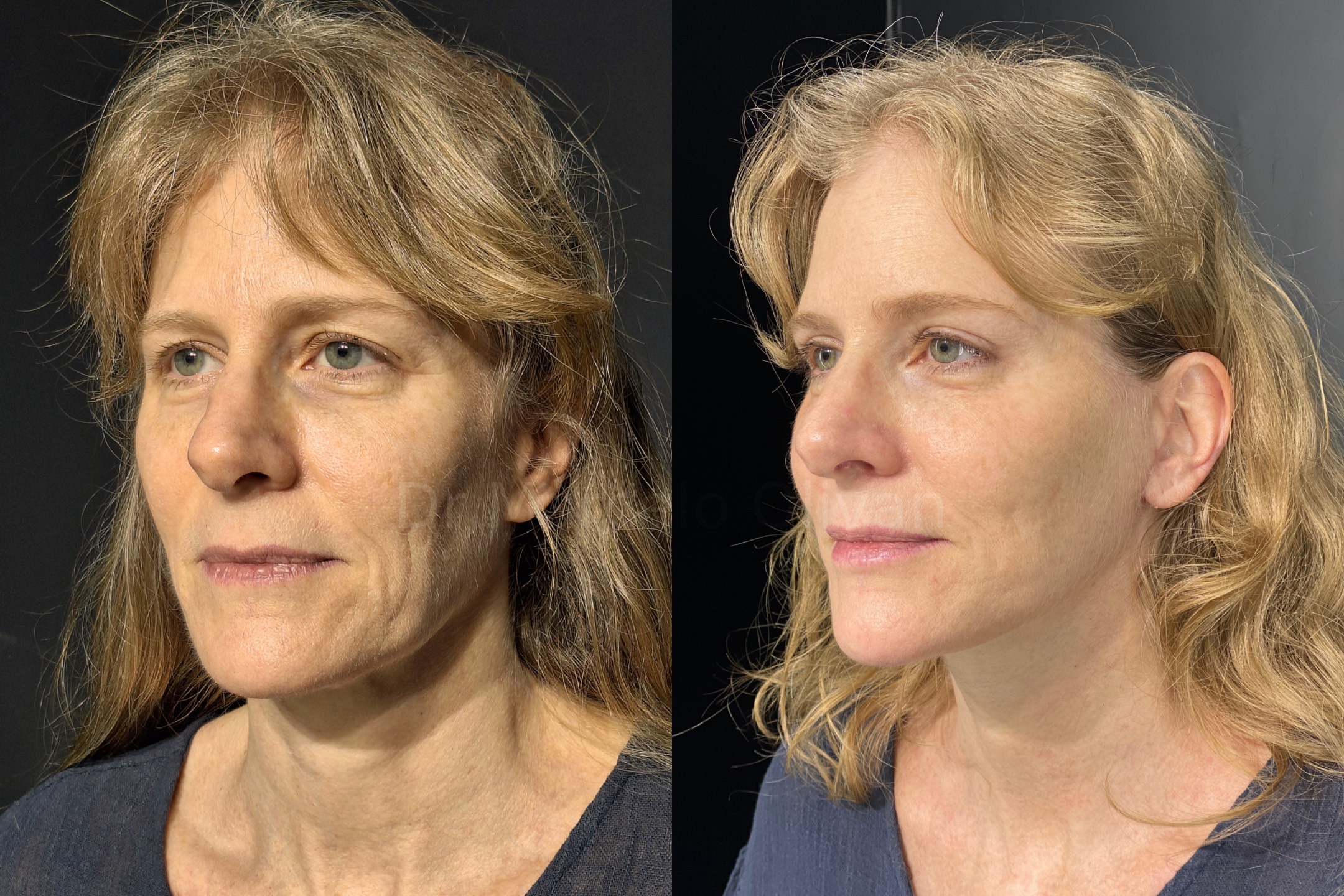 Before and after - angle view C (Stage 2)