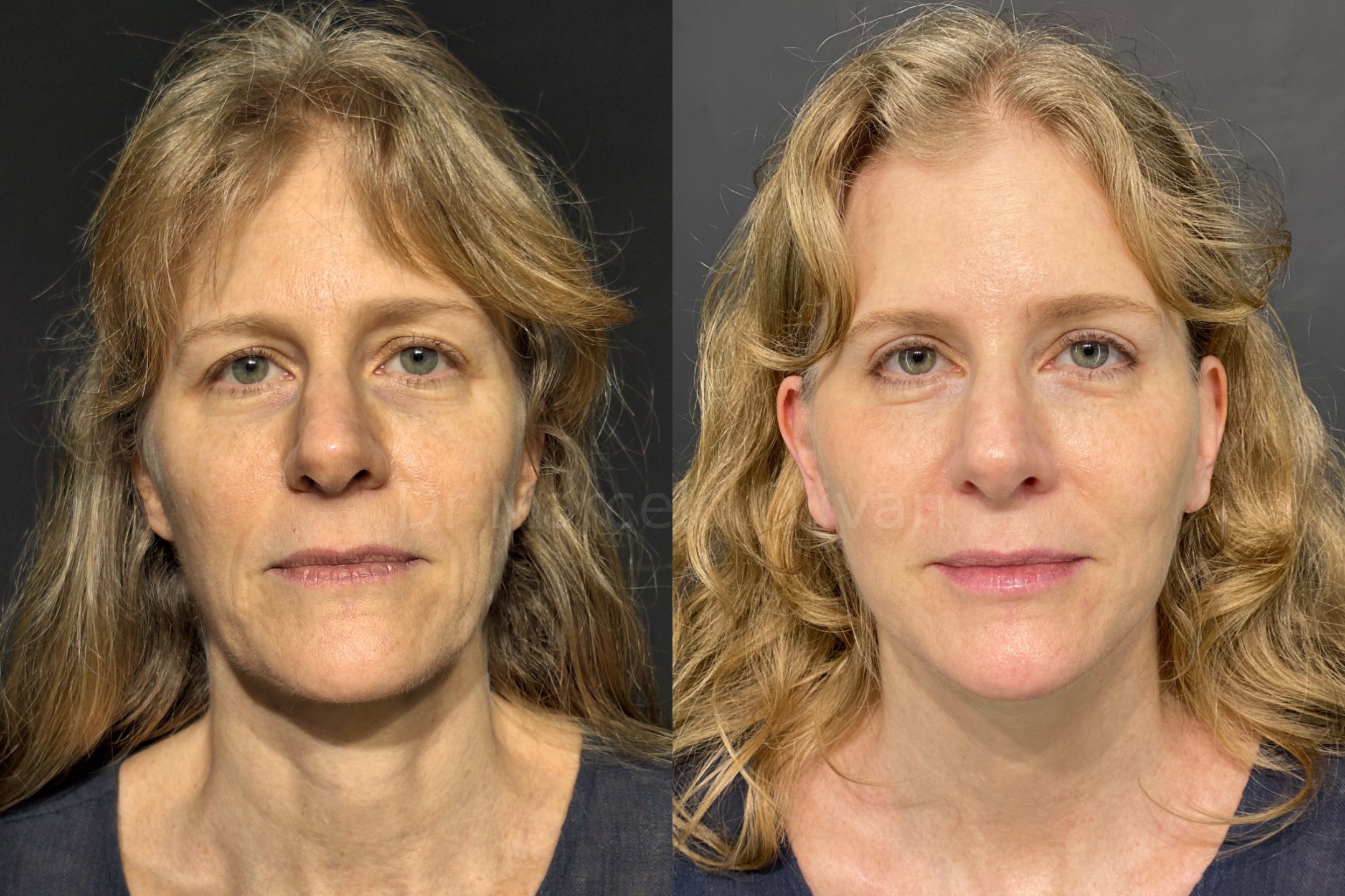 Before and after - frontal view (Stage 2)