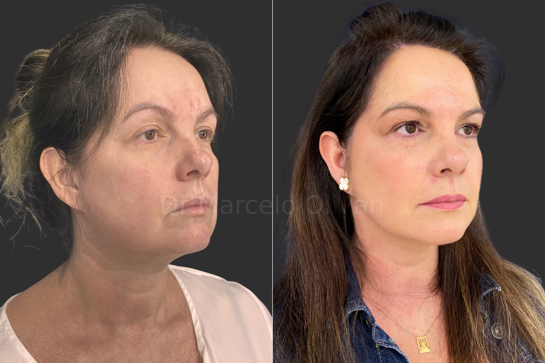 Before and after - angle view