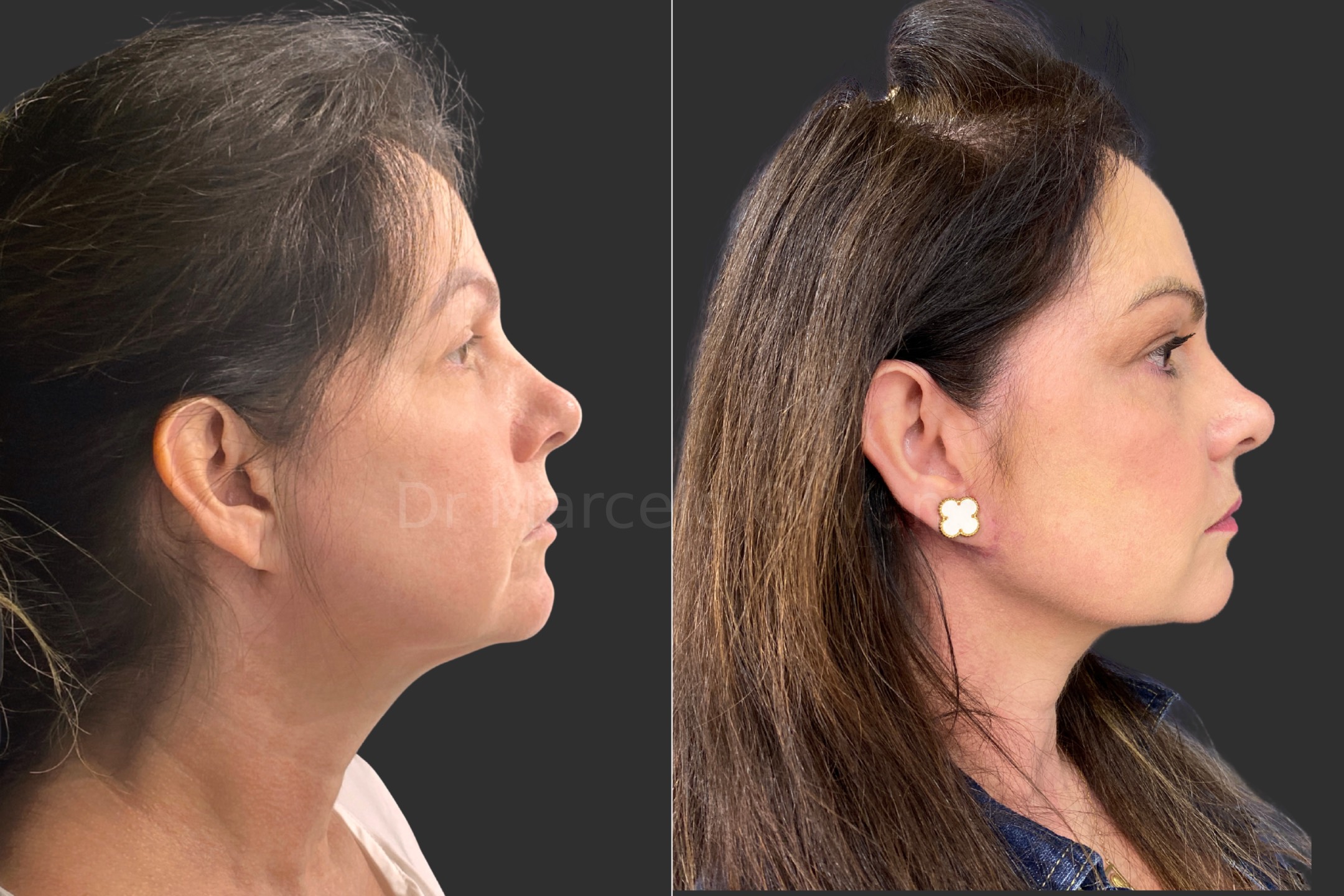 Before and after - side view